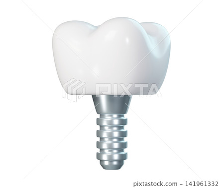 implant, tooth, dental 141961332