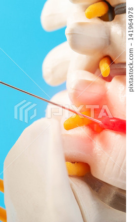 Medical demonstration of spinal injection procedure on human vertebral column model, illustrating needle insertion into intervertebral disc with indication of pain area, vertical photo. Pain relief Medical demonstration of spinal injection procedure on human vertebral column model, illustrating needle insertion into intervertebral disc with indication of pain area, vertical photo. Pain relief 141964978