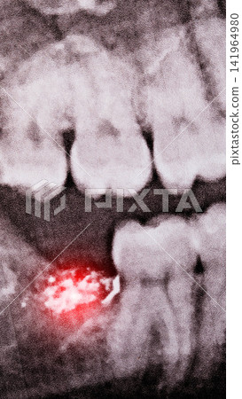 Dental X-ray image of human teeth showing bright red spot indicating tooth decay or gum inflammation problem pain of root of tooth in jaw bone medical diagnosis vertical photo. Wisdom tooth removal Dental X-ray image of human teeth showing bright red spot indicating tooth decay or gum inflammation problem pain of root of tooth in jaw bone medical diagnosis vertical photo. Wisdom tooth removal 141964980