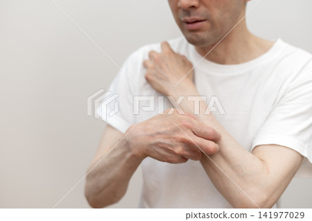 一位中年男子因手臂奇癢難耐而抓癢至皮開肉綻。癢死了,真癢。 一位中年男子因手臂奇癢難耐而抓癢至皮開肉綻。癢死了,真癢。 141977029