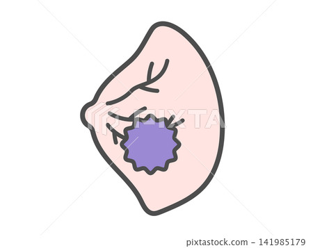 Breast cancer illustration Breast cancer illustration 141985179
