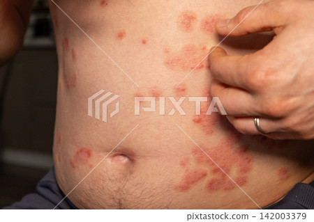 Red, itchy patches are visible on the abdomen, indicating psoriasis flare ups, while a hand scratches the affected skin in a home setting. Red, itchy patches are visible on the abdomen, indicating psoriasis flare ups, while a hand scratches the affected skin in a home setting. 142003379