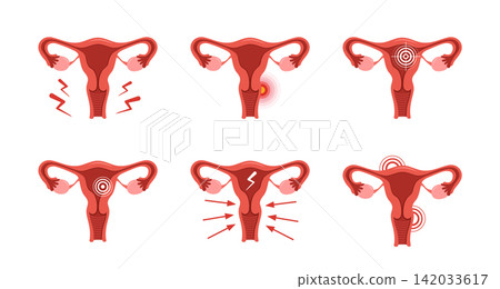 Uterus pain. Human internal organ disease. reproductive system medical diagnosis and treatment. Set vector illustration in flat style Uterus pain. Human internal organ disease. reproductive system medical diagnosis and treatment. Set vector illustration in flat style 142033617