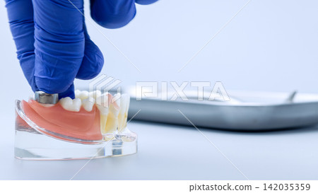 Dentist Hand in Blue Glove Placing Metal Crown or Implant Attachment on Anatomical Jaw Model Dentist Hand in Blue Glove Placing Metal Crown or Implant Attachment on Anatomical Jaw Model 142035359