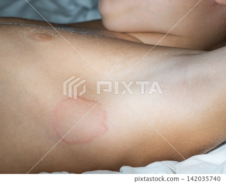 Close-up image of the body of a caucasian boy suffering from severe hives Close-up image of the body of a caucasian boy suffering from severe hives 142035740