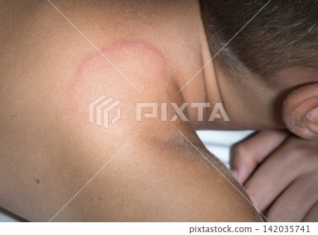 Close-up image of the body of a caucasian boy suffering from severe urticaria Close-up image of the body of a caucasian boy suffering from severe urticaria 142035741