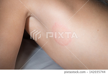 Close-up portrait of a little boy with a red hives on his body Close-up portrait of a little boy with a red hives on his body 142035744