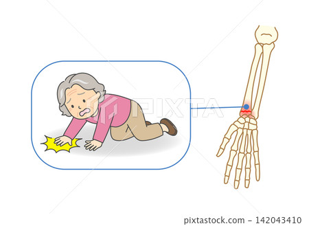 一幅插圖,描繪了一位老婦人摔倒後伸出雙手緩衝,結果導致橈骨骨折的情景。 一幅插圖,描繪了一位老婦人摔倒後伸出雙手緩衝,結果導致橈骨骨折的情景。 142043410