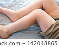 Child scratch body has sensitive itchy skin. Bodily rash. Kid allergy closeup. Little baby scratches eruption. Irritation, hive. Pruritus. Mosquito insect bite. Red from sunburn, Seborrheic Dermatitis 142048865