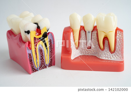 Dental implant, artificial tooth roots into jaw, root canal of dental treatment, gum disease, teeth model for dentist studying about dentistry. Dental implant, artificial tooth roots into jaw, root canal of dental treatment, gum disease, teeth model for dentist studying about dentistry. 142102000