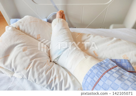 一名住院病人(垂直姿勢)在足部手術後休息,打著石膏的腿放在抬高腿墊上。 一名住院病人(垂直姿勢)在足部手術後休息,打著石膏的腿放在抬高腿墊上。 142105071