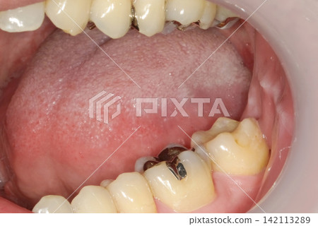 Two molars with metal and composite resin fillings. Two molars with metal and composite resin fillings. 142113289