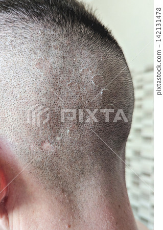 Close-up of shaved scalp with visible dandruff, peeling flakes, dry skin and small irritated bumps around short hair stubble Close-up of shaved scalp with visible dandruff, peeling flakes, dry skin and small irritated bumps around short hair stubble 142131478
