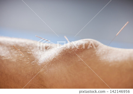Acupuncture, knee and treatment of body in healthcare, healing muscle and relief from pain. Healthy, patient and physiotherapy with dry needling to relax at chiropractor or holistic care for injury Acupuncture, knee and treatment of body in healthcare, healing muscle and relief from pain. Healthy, patient and physiotherapy with dry needling to relax at chiropractor or holistic care for injury 142146956