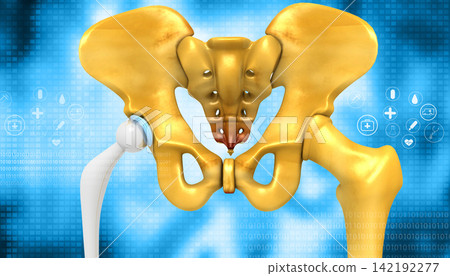 Human hip replacement Human hip replacement 142192277
