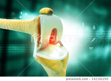 Knee replacement on medical background Knee replacement on medical background 142192293