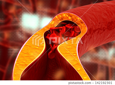 Atherosclerosis, Cholesterol plaque in artery Atherosclerosis, Cholesterol plaque in artery 142192301