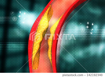 Cholesterol blocked artery on medical background Cholesterol blocked artery on medical background 142192340