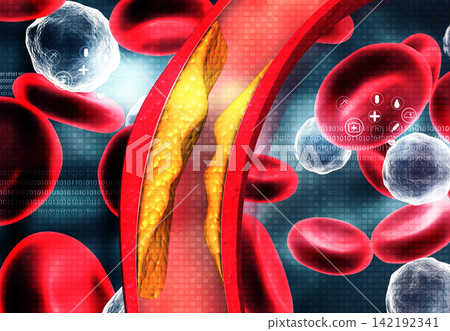 Cholesterol blocked artery on medical background Cholesterol blocked artery on medical background 142192341