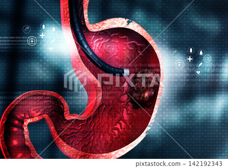 Stomach cancer, Stomach endoscopy Stomach cancer, Stomach endoscopy 142192343