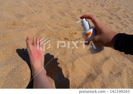 Sunburn on a girl's leg on the beach, skincare for summer holiday in South Korea 142199265