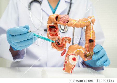 Colorectal cancer, doctor holding intestine colon human anatomy model. Colorectal cancer, doctor holding intestine colon human anatomy model. 142205133