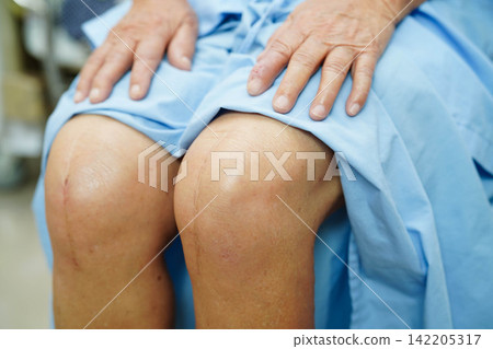 Asian elderly woman patient with scar knee replacement surgery in hospital. Asian elderly woman patient with scar knee replacement surgery in hospital. 142205317