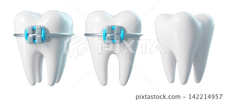 Set of 3d teeth with braces from different angles, bracket frame, realistic render icon isolated. Infographics installation of corrective brace Set of 3d teeth with braces from different angles, bracket frame, realistic render icon isolated. Infographics installation of corrective brace 142214957