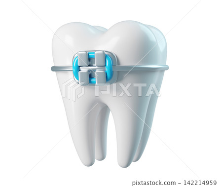 3d Tooth with a braces, bracket frame, realistic render icon isolated. Infographics installation of corrective brace 3d Tooth with a braces, bracket frame, realistic render icon isolated. Infographics installation of corrective brace 142214959