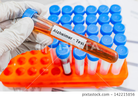 blood sample in lab test tube for Alzheimer test blood sample in lab test tube for Alzheimer test 142215856