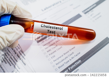 blood sample in lab test tube for Cholesterol test blood sample in lab test tube for Cholesterol test 142215858