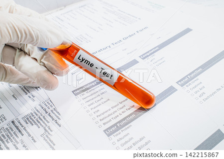 blood sample in lab test tube for Lyme test blood sample in lab test tube for Lyme test 142215867