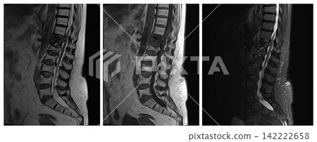 Sagittal Lumbar Spine MRI Comparison of T2 T1 and STIR Sequences 142222658