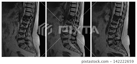 Sequential Sagittal T2 MRI Slices of Lumbar and Lumbosacral Spine 142222659