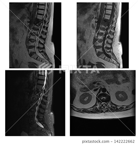 Multiplanar MRI Panel of Lumbar Spine with T1 T2 STIR and Axial Views Multiplanar MRI Panel of Lumbar Spine with T1 T2 STIR and Axial Views 142222662