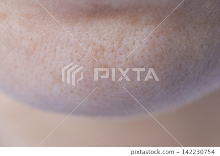 Lower Face Chin Showing Clustered Open Pores And Uneven Texture In Macro Close Up Clinical Setting 142230754
