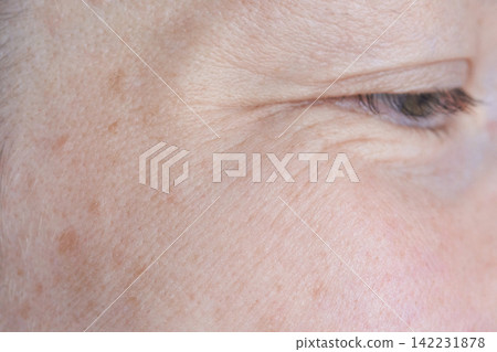 Outer Eye Area Showing Crow Feet Wrinkles And Age Spots In Close Up Clinical View On Temple Outer Eye Area Showing Crow Feet Wrinkles And Age Spots In Close Up Clinical View On Temple 142231878