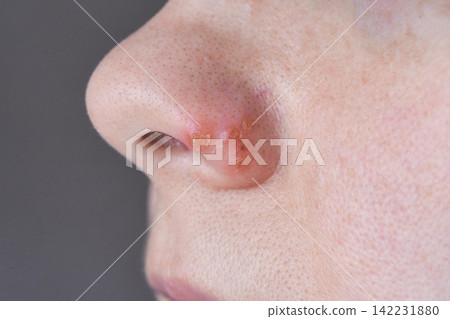 Nose Showing Crusted Sores And Localized Inflammation Near Nostril On Facial Skin Closeup Clinical 142231880