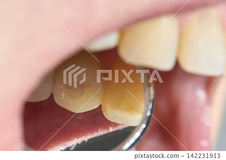 Close Up Dental Mirror Revealing Cavity In Lower Molar During Intraoral Examination Inside Clinical Close Up Dental Mirror Revealing Cavity In Lower Molar During Intraoral Examination Inside Clinical 142231913