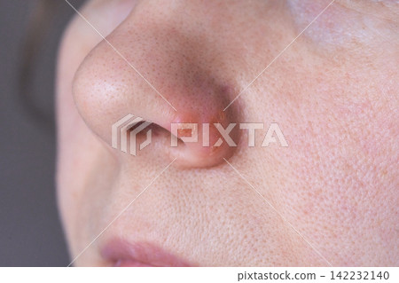 Close Up Nostril With Small Crusted Lesion On Nasal Rim Showing Skin Texture And Pore Detail Under Close Up Nostril With Small Crusted Lesion On Nasal Rim Showing Skin Texture And Pore Detail Under 142232140