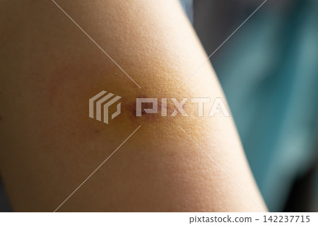 Bruise injury found on the female arm 142237715