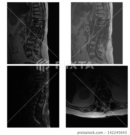 Postoperative Lumbar Spine MRI Panel with T1 T2 STIR and Axial Views Postoperative Lumbar Spine MRI Panel with T1 T2 STIR and Axial Views 142245643