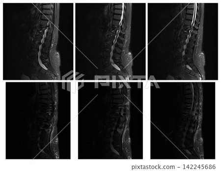 Three Sagittal STIR Lumbar MRI Slices Before and After Spinal Surgery Three Sagittal STIR Lumbar MRI Slices Before and After Spinal Surgery 142245686