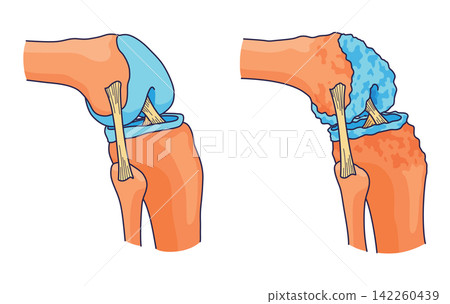 Rheumatoid arthritis. A comparison between a healthy knee and joint with Bone erosion, Cartilage wears, Reduced joint space and Swollen inflamed synovial membrane. Vector illustration Rheumatoid arthritis. A comparison between a healthy knee and joint with Bone erosion, Cartilage wears, Reduced joint space and Swollen inflamed synovial membrane. Vector illustration 142260439