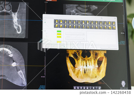 Close-Up of Laptop Screen Displaying 3D Dental CBCT Computed Tomography Diagnostics Software 142268438