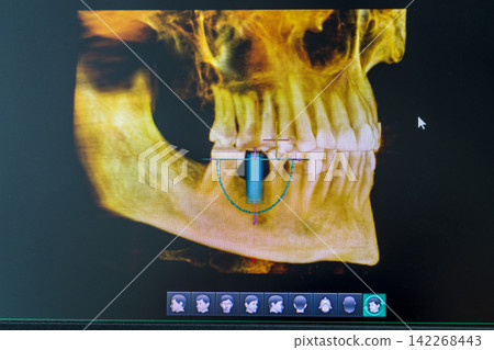 Close-Up of Laptop Screen Displaying 3D Dental CBCT Computed Tomography Diagnostics Software Close-Up of Laptop Screen Displaying 3D Dental CBCT Computed Tomography Diagnostics Software 142268443