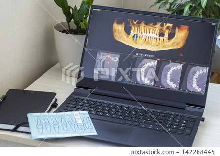 Close-Up of Laptop Screen Displaying 3D Dental CBCT Computed Tomography Diagnostics Software Close-Up of Laptop Screen Displaying 3D Dental CBCT Computed Tomography Diagnostics Software 142268445