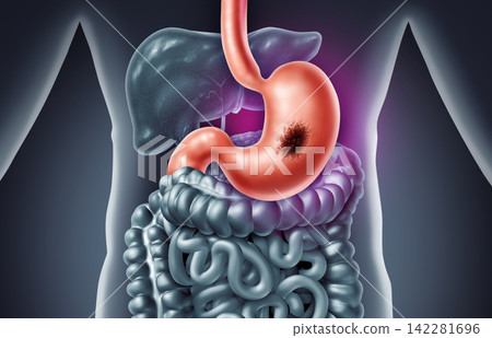 Stomach Tumor Stomach Tumor 142281696