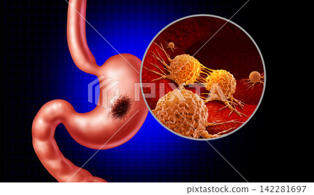 Stomach Cancer Stomach Cancer 142281697