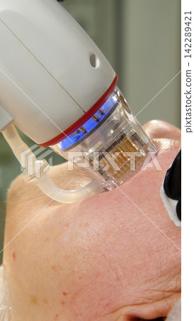 A multifunctional device for microneedle RF lifting. Aesthetic procedures for non-surgical lifting, smoothing fine lines, minimizing pores, regulating sebum production, and evening out skin texture. A multifunctional device for microneedle RF lifting. Aesthetic procedures for non-surgical lifting, smoothing fine lines, minimizing pores, regulating sebum production, and evening out skin texture. 142289421